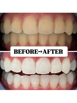 ホワイトニングサロン 豊中/Before&After美白ホワイトニング