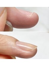 リファーレ(RIFARE)/【深爪矯正】ビフォーアフター