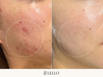 レロ 恵比寿店(LELLO)/鎮静ケアで肌トラブルを改善