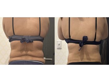 シャルム(CHARME)/気になる部分に脂肪冷却