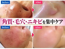 サロンドエステケイワイ(de KY)の雰囲気（【￥22,000⇒体験90分￥6,600】ダイヤモンドピーリング＆導入）