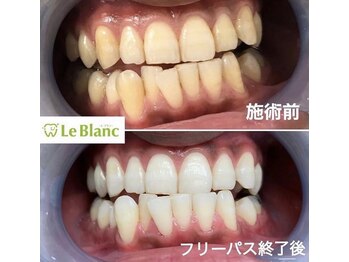 ルブラン 奈良店(Le Blanc)/歯の根元の黄ばみ