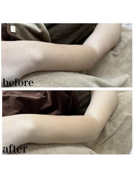 ラクシー 御徒町(luxssy)/腕シェービング