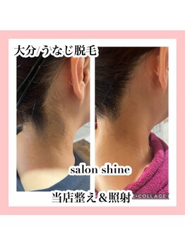 サロンシャイン(Salon Shine)/うなじ脱毛照射後
