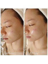 ココプレジール(Cocoplaisir)/フェイシャル/毛穴/ブツブツ