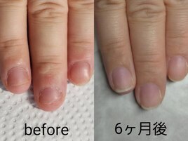 深爪矯正6ヶ月、噛む癖ありの方