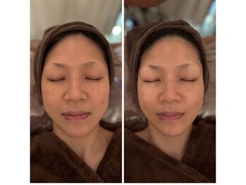 ドクター ヴィーナス/小顔ポレーション石膏パック1回