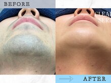 ラッシュ(RUSH)/9ヶ月でヒゲ脱毛完了！