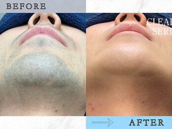 ラッシュ(RUSH)/9ヶ月でヒゲ脱毛完了!