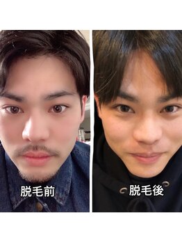 メンズガーデン(men's Garden)/ヒゲ脱毛効果