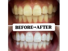 ホワイトニングサロン 豊中/Before&After美白ホワイトニング