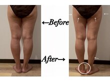 ステラ(Stella)/痩身(脚&お尻まわり)