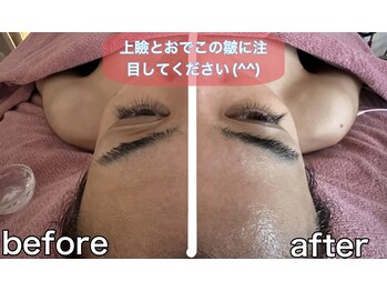 サロンデイジー(Salon Daisy)/Matrix小顔フェイシャル施術一回