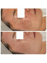 リセル(RE.cell)/シミケア8回＋肌質改善2回