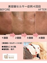 瑞 鍼灸院/にきび　美容鍼セルサー4回