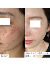 エヌプラスビューティー(N+beauty)/長年のシミ悩みに