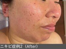 オアシスラグーン(OASIS LAGOON)/ニキビ改善（症例2 after）