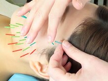 アオヤマ サロン ワイゼット(AOYAMA SALON YZ)の雰囲気（国産の使い捨て鍼を使用。美容鍼が初めての方にも◎）