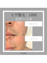 ロカヒ(Lokahi)/ヒゲ脱毛10回