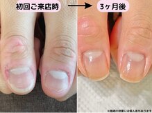 カピリナ(Ka Pilina)/自爪育成・川崎
