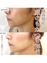 マヴィ 香里園店(MavY.)/水光注入と筋膜リリース最強小顔