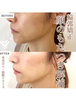 マヴィ 香里園店(MavY.)/水光注入と筋膜リリース最強小顔