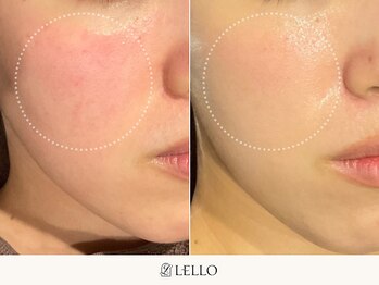 レロ 恵比寿店(LELLO)/肌荒れによる赤みケアが得意です