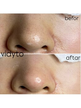 ヴィディトゥ(vidyto)/毛穴ケア+エンビロン