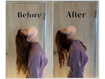 整体ラルース 中目黒(LALUZ)/20代 女性 ストレートネック改善