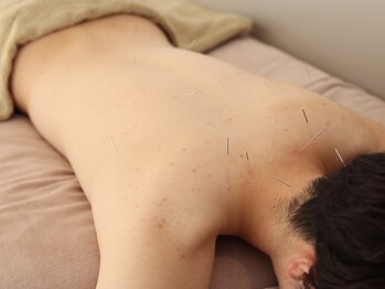 ハリノヒ 本町院/肩こり・背中のハリ改善鍼灸整体