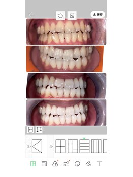 コントレール 歯ぁと(CONTRAIL)/ホームホワイトニングのあとは