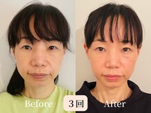 ロシュニ/40代 お悩み:たるみ(ほうれい線)