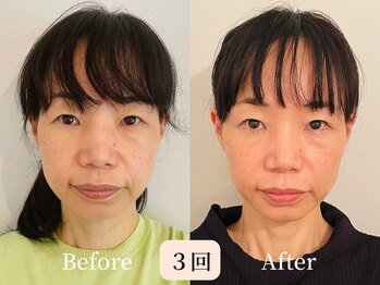 ロシュニ/40代 お悩み:たるみ(ほうれい線)