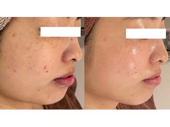 ミベル(MeBell)/毎月のケア/肌質改善/ブライダル