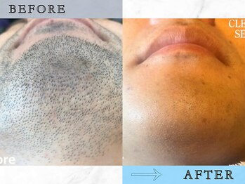 ラッシュ(RUSH)/10年悩んだ青ヒゲがツルツルに!