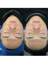 オンフリーク 渋谷店(salon OnFleek!)/美肌フェイシャルワックス脱毛