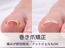 【痛みを我慢しない】巻き爪矯正