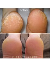 メゾリーナ(MAISOReNA)/水光ピーリング