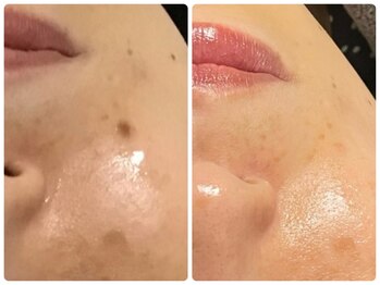 ルクシア(RUXCIA)/ビフォーアフター/CIVASAN３ヶ月