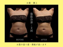 ブルースター 上小田井店(Blue Star)/お腹２・背中２カップ×２回