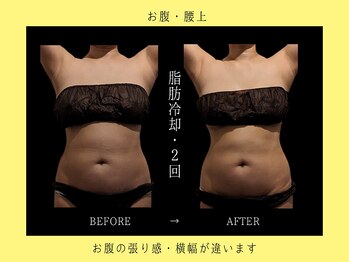 ブルースター 上小田井店(Blue Star)/お腹2・背中2カップ×2回