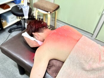 ふじ鍼灸整骨院/【鍼灸】肩こり・頭痛の施術