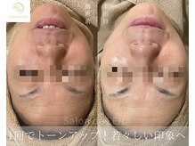 サロンドレナ 名駅店/ハーブピーリング サロンドレナ