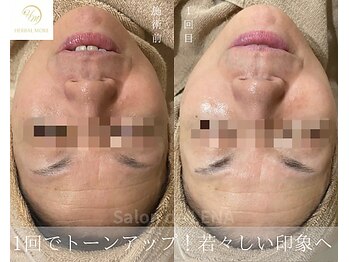 サロンドレナ 名駅店/ハーブピーリング サロンドレナ