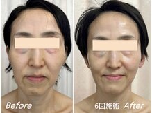 ドクターボディ 新宿店(Dr.Body)/【たるみ/顎の歪み/左右差50代】