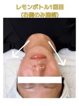 ハウピア(Haupia)/ダウンタイムゼロで小顔に