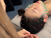 アロエベル(aloe Belle)/美容鍼