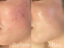 ハーブピーリング&毛穴洗浄専門店 肌REVO 高田馬場店[ニキビ/毛穴/たるみ/美白/シミ]の雰囲気（丁寧なカウンセリングであなたにピッタリの施術をお届けします◎）