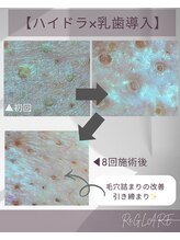 リグレア 浦安(Re.GLARE)/毛穴の変化