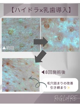 リグレア 浦安(Re.GLARE)/毛穴の変化